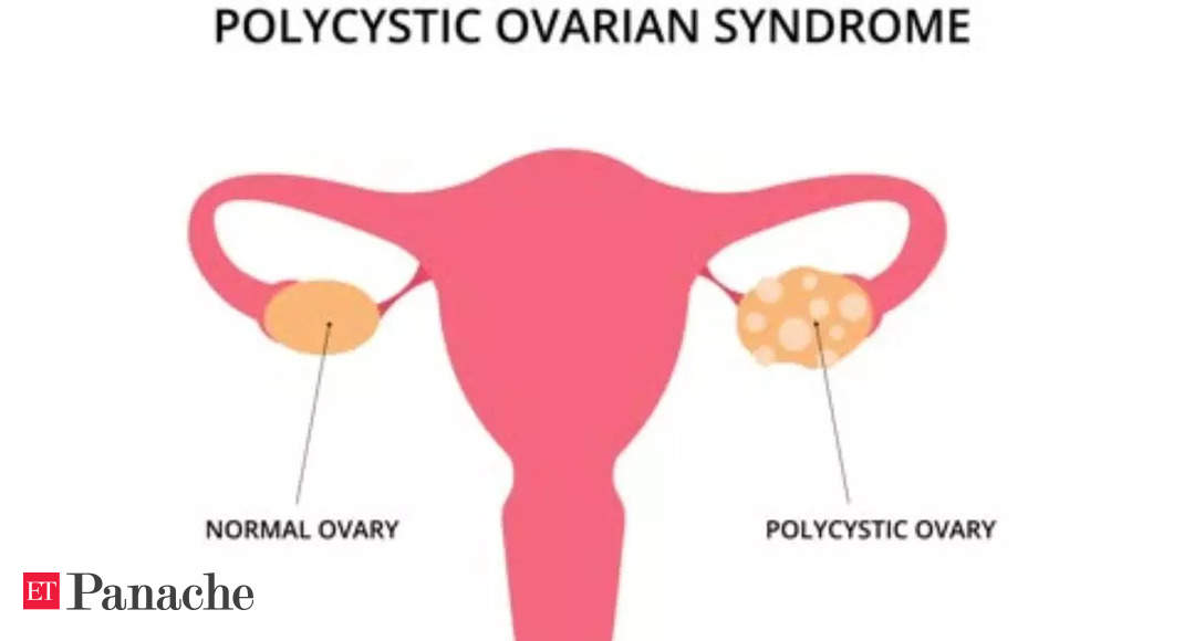 Ketogenic Diet May Boost Weight Loss and Promote Regular Cycles in Women with PCOS