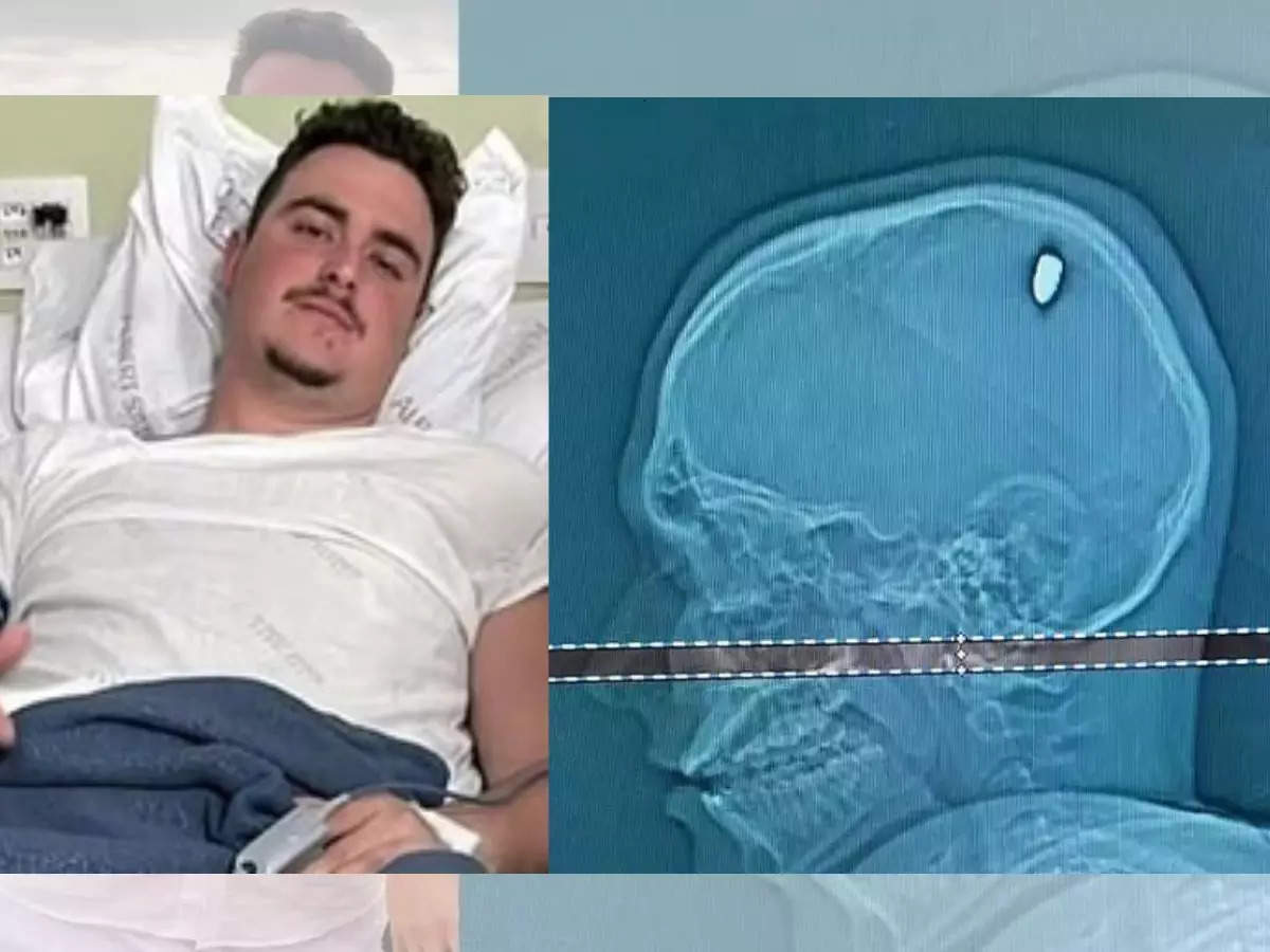 Brazilian Man, 21, Parties for 4 Days with Bullet Lodged in His Head